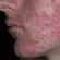 Akne na licu: uzroci i metode uklanjanja Zašto se prištići stalno pojavljuju na licu
