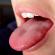 Domningar i tungan - symtom, orsaker och behandlingstaktik