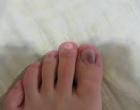 Necht zmodral na palci nohy: príznaky, príčiny, liečba Necht je modrý a odlupuje sa