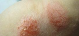 Allergiás ekcéma: okok, tünetek, hogyan kell kezelni a lóerővel kezelhető az allergiás ekcéma