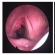 Papilomatóza hrtana - liečba papilómov v krku Liečba papilomatózy hrtana