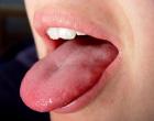 Dilin uyuşması - simptomlar, səbəblər və müalicə taktikası