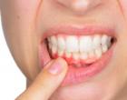 Солоний присмак у роті - причини та наслідки